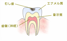 C1：エナメル質レベル