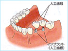 インプラント