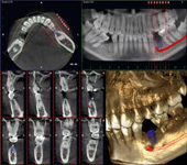 インプラント治療の3次元画像