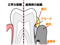 歯周病の原因